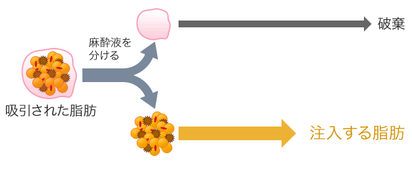 脂肪注入のイメージ